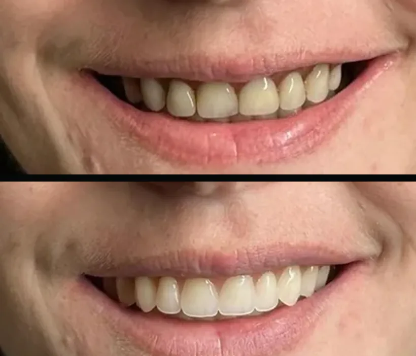 Metamorfoza uśmiechu — proteza zębowa przed i po wymianie